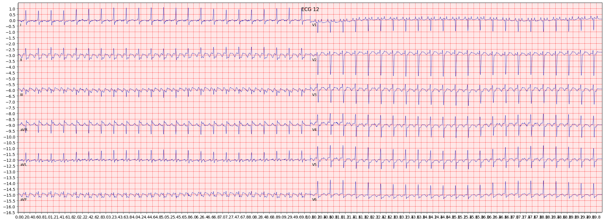 atrial futter (AFLT) example 20