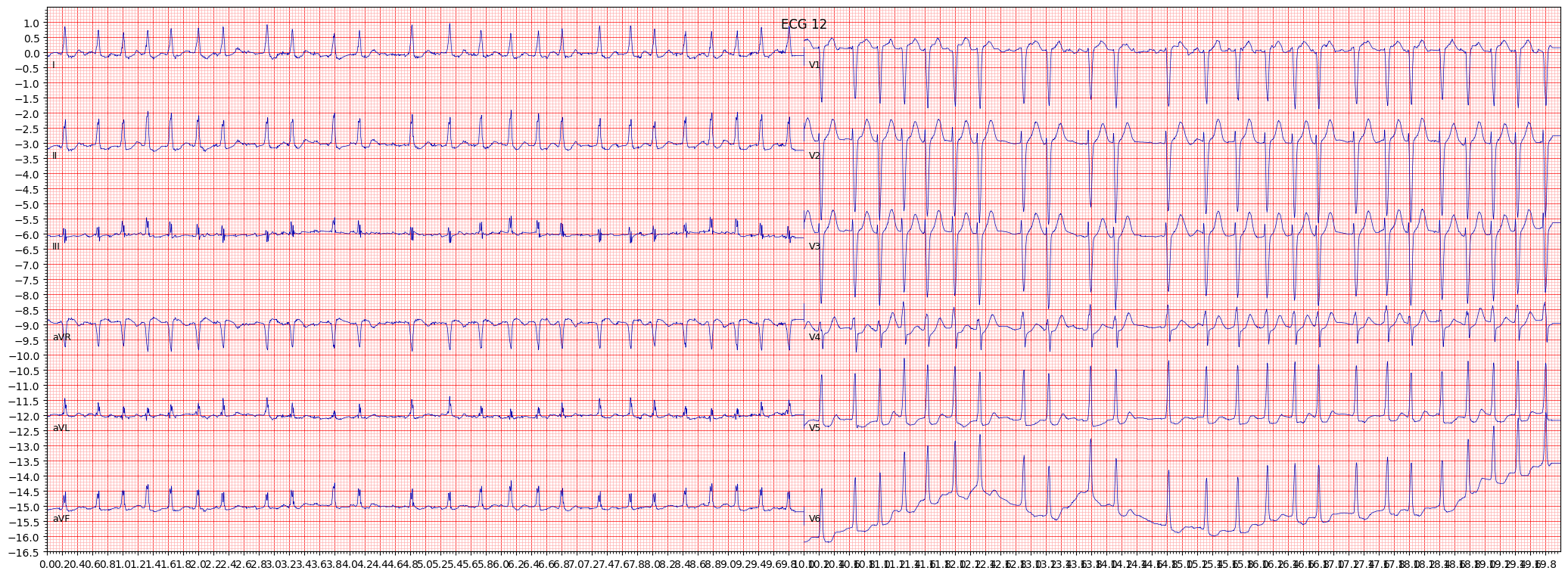 non-specifc ischemic (ISC_) example 2001