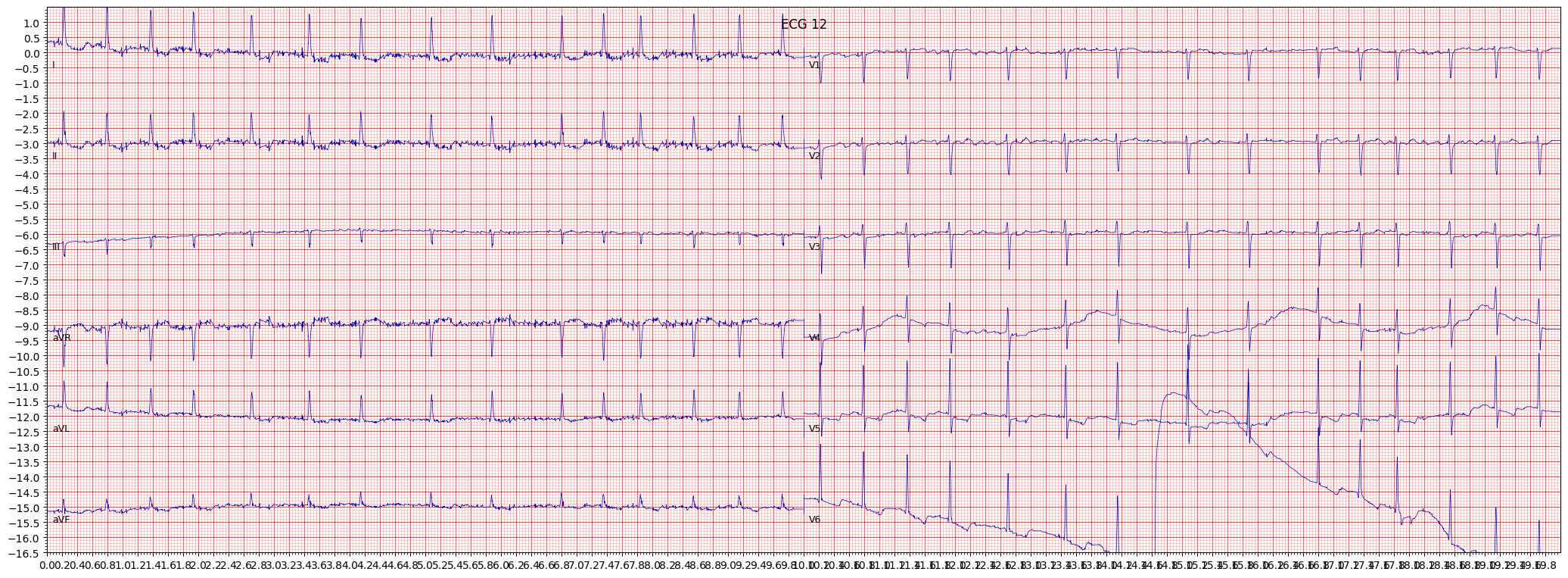 ischemic in anterolateral leads (ISCAL) example 2004