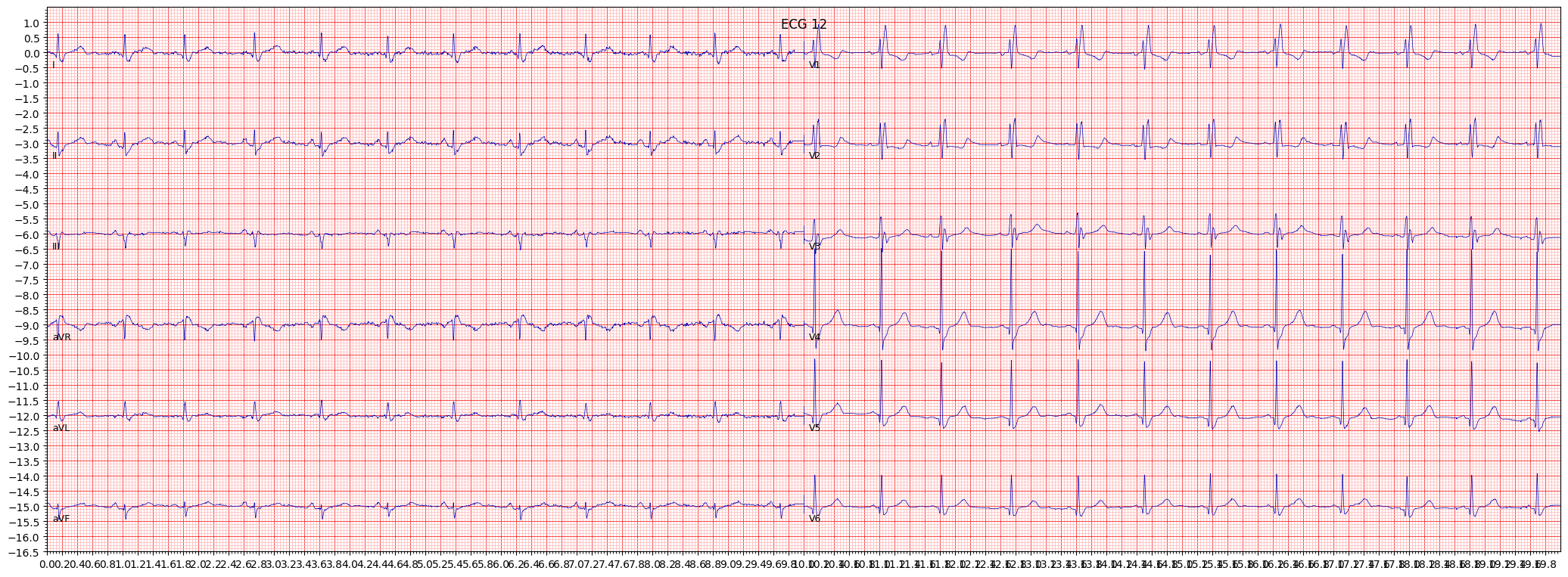 complete right bundle branch block (CRBBB) example 2017