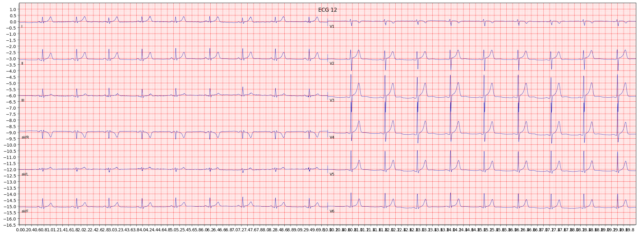 Normal ECG (NORM) example 203