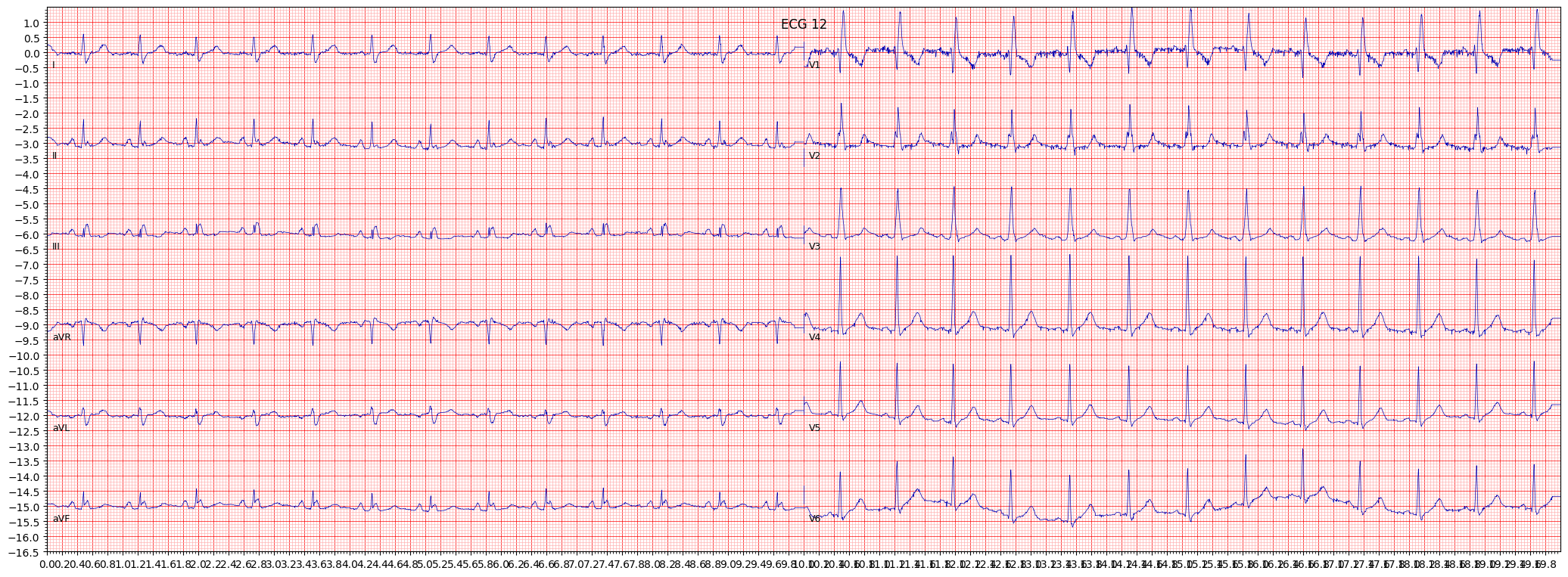 complete right bundle branch block (CRBBB) example 2034