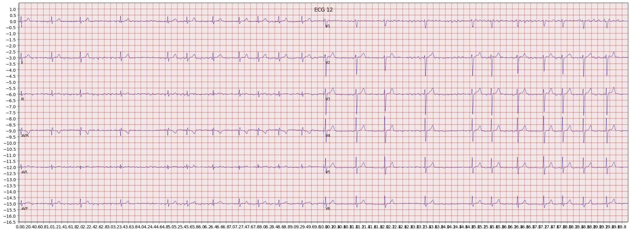 atrial fbrillation (AFIB) example 20406