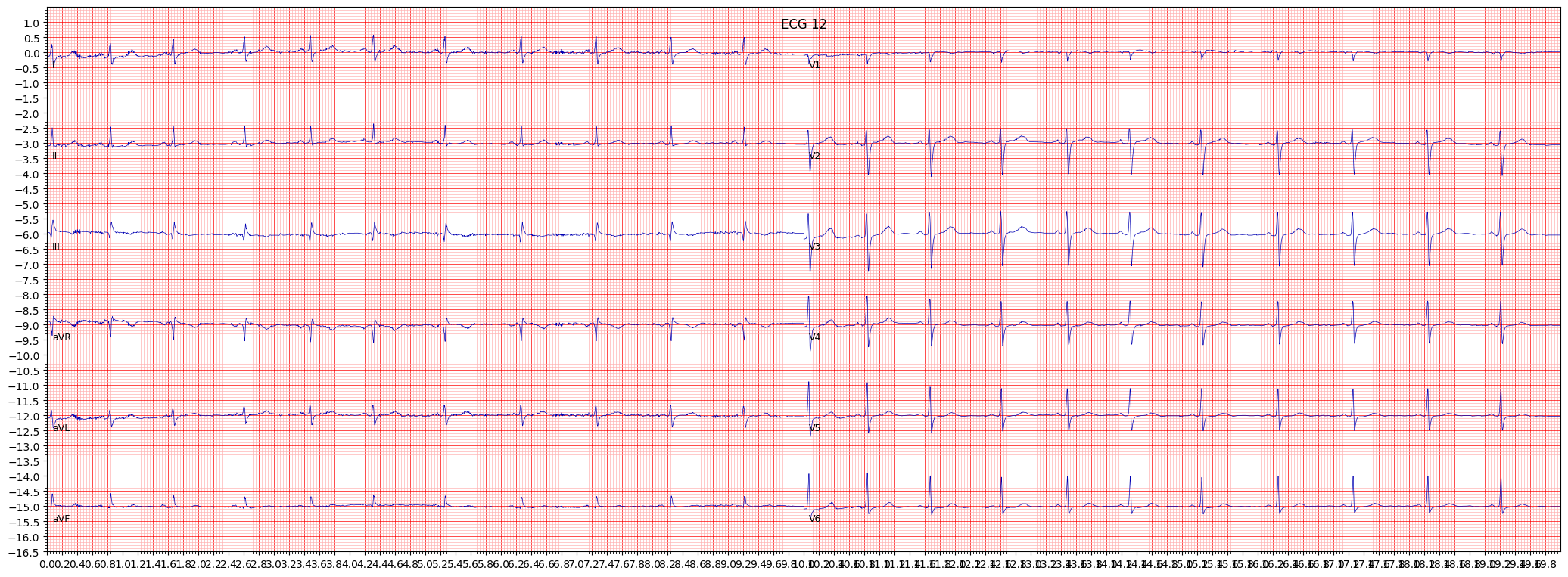 Normal ECG (NORM) example 205