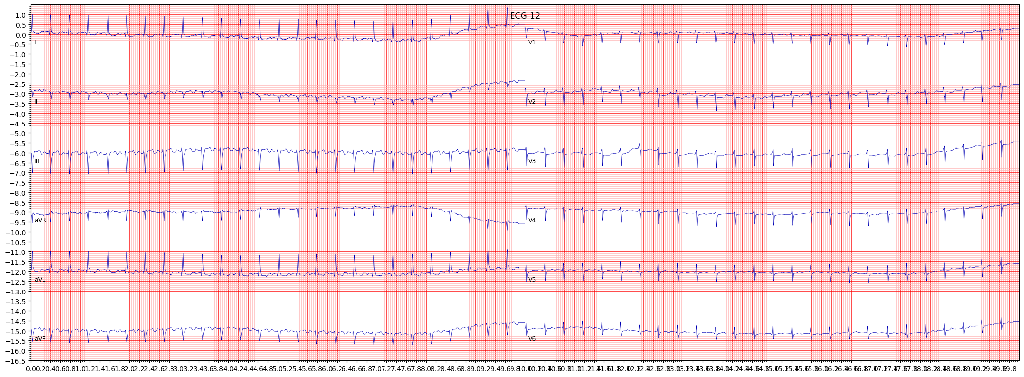 paroxysmal supraventricular tachycardia (PSVT) example 2051