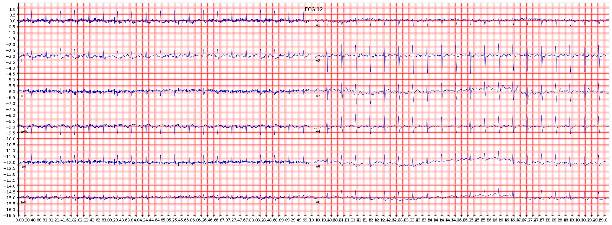 ischemic in lateral leads (ISCLA) example 21116