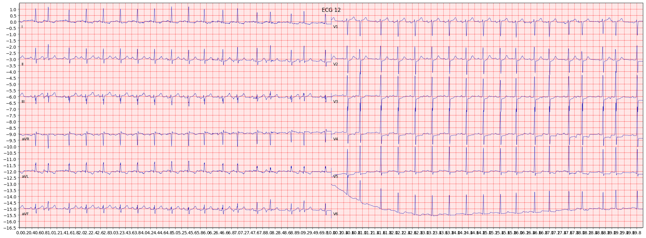 ischemic in anterolateral leads (ISCAL) example 2160