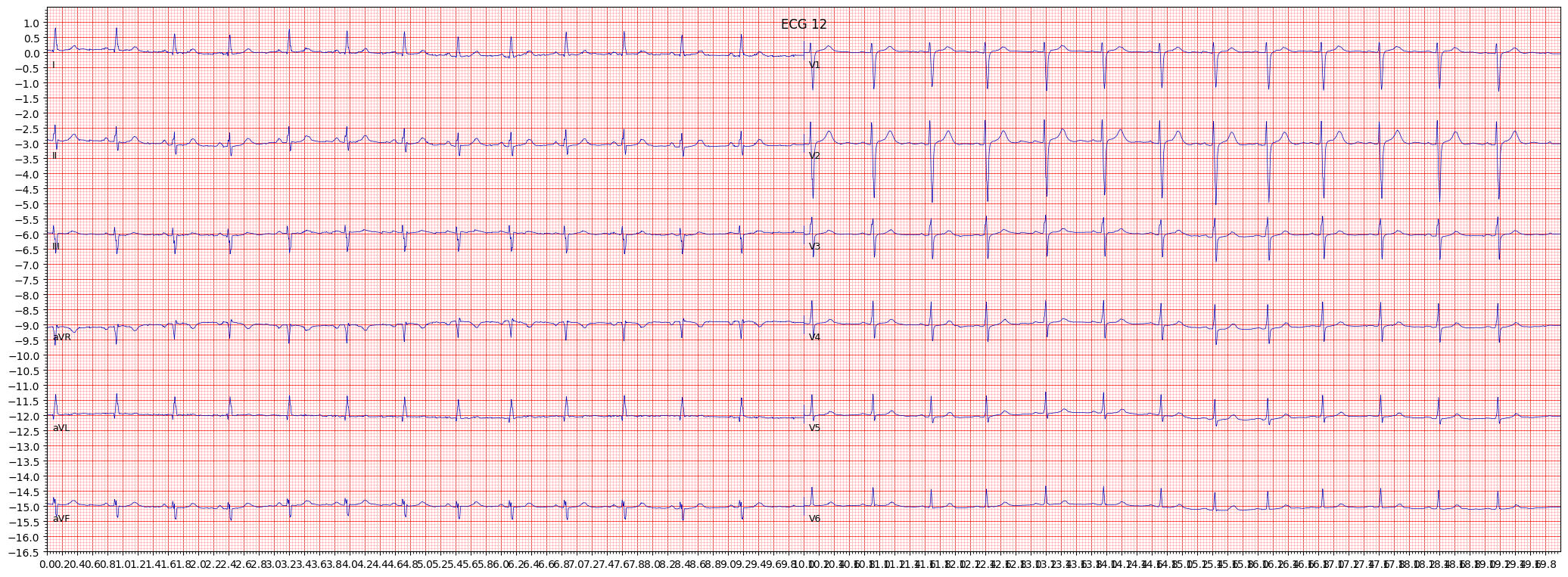 non-diagnostic T abnormalities (NDT) example 22