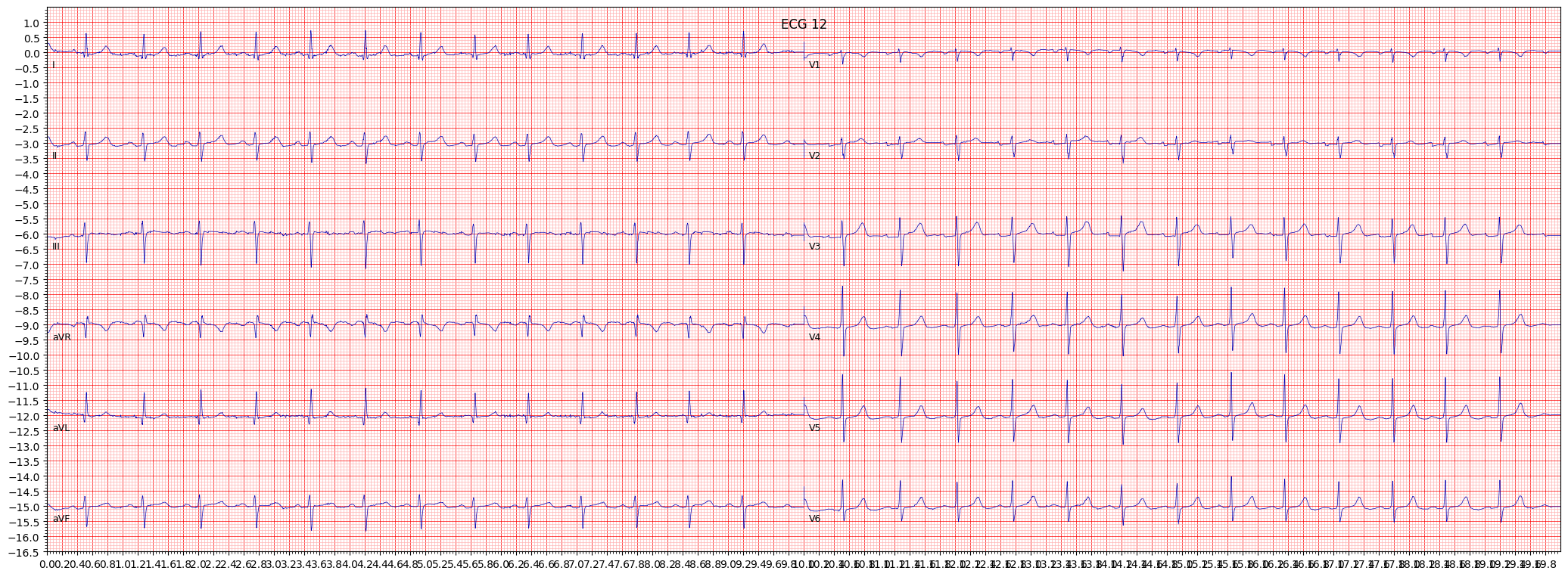 left anterior fascicular block (LAFB) example 220