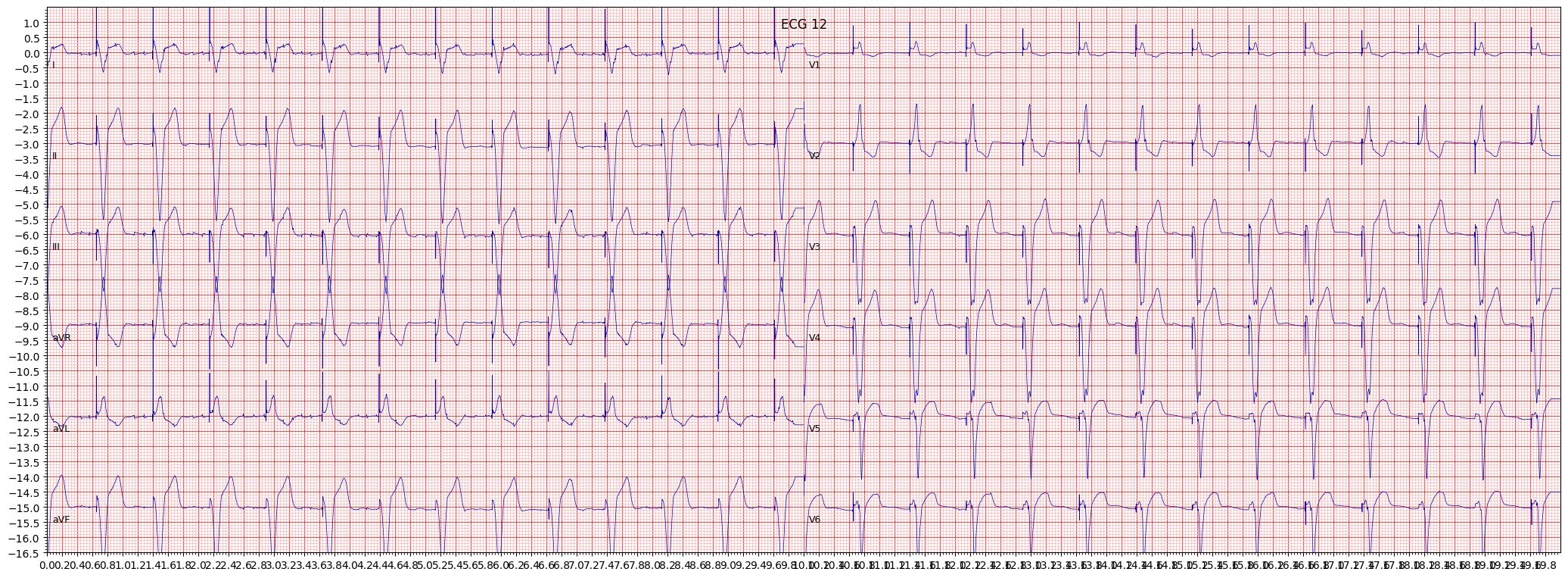 normal functioning artifcial pacemaker (PACE) example 2218