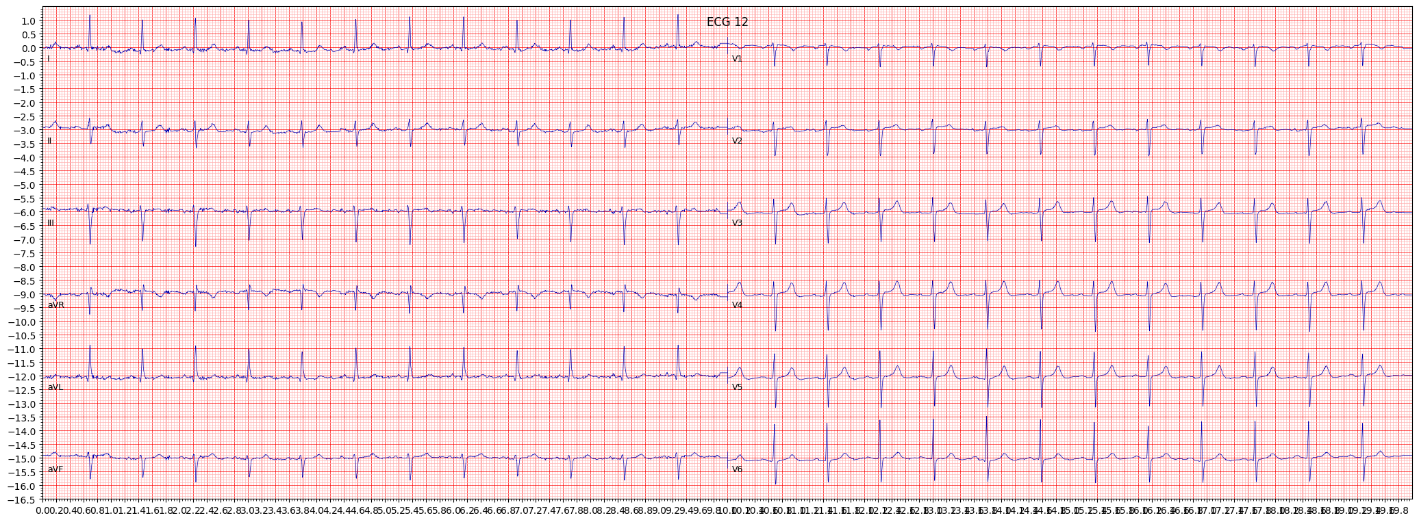 left anterior fascicular block (LAFB) example 226