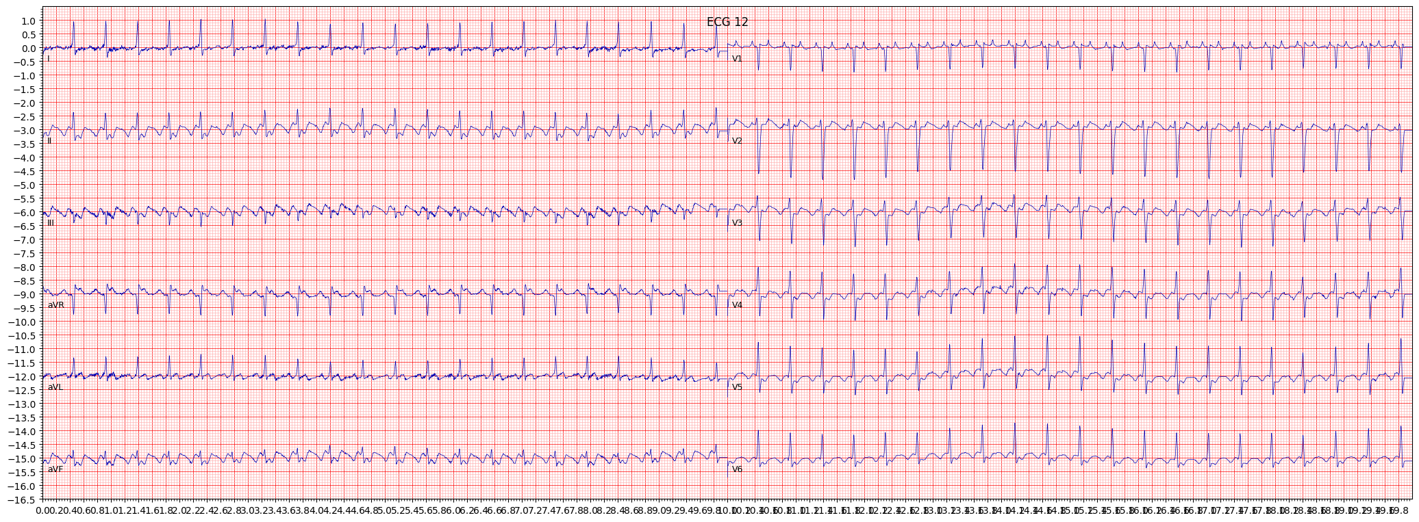 atrial futter (AFLT) example 23