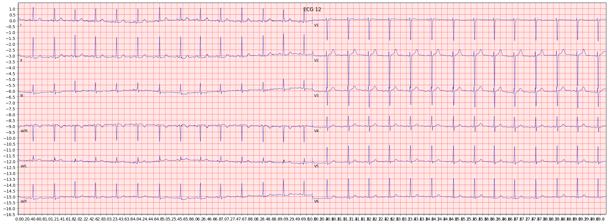 Normal ECG (NORM) example 230
