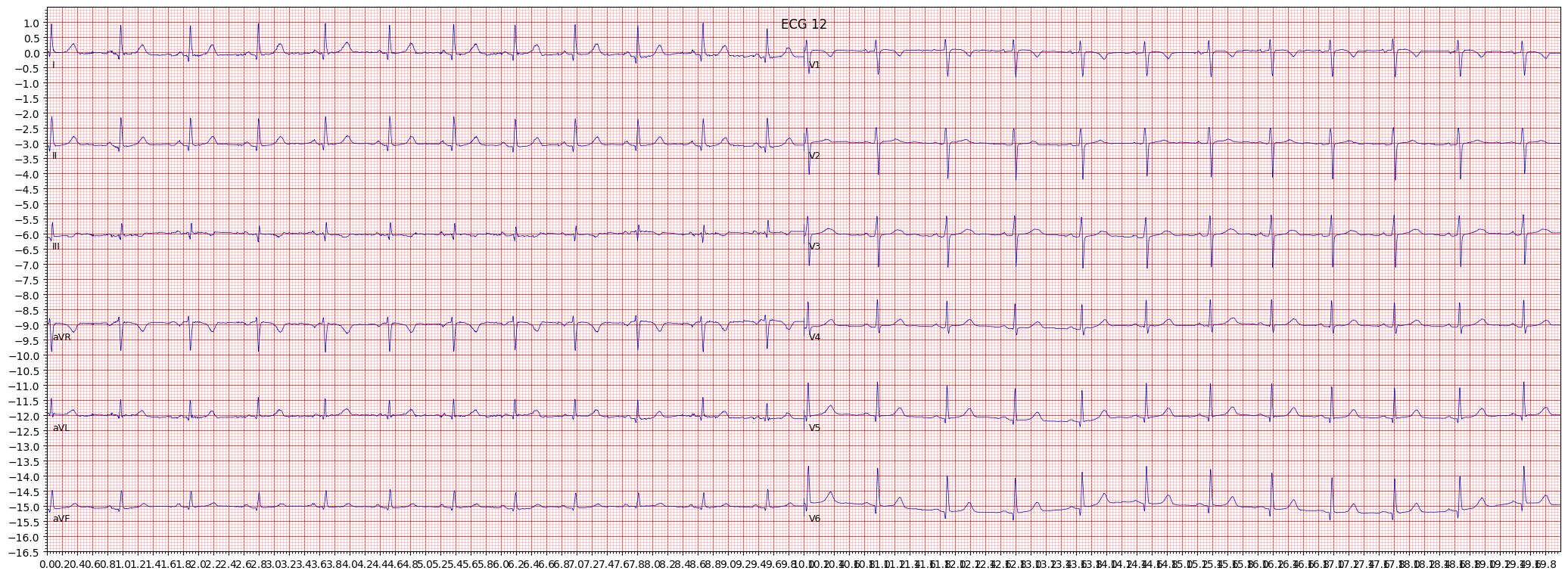 septal hypertrophy (SEHYP) example 2415