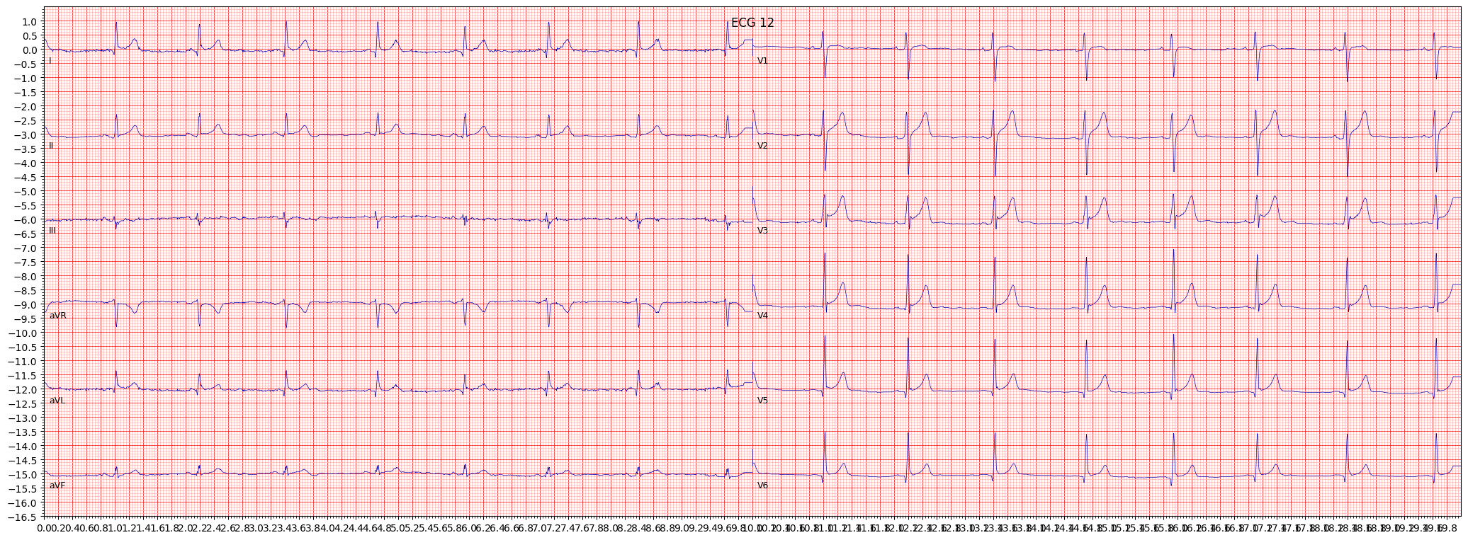 non-specifc intraventricular conduction disturbance (block) (IVCD) example 2419