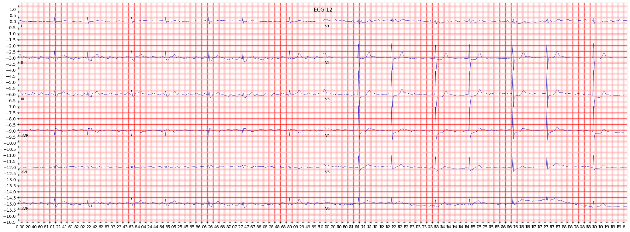 atrial futter (AFLT) example 2430