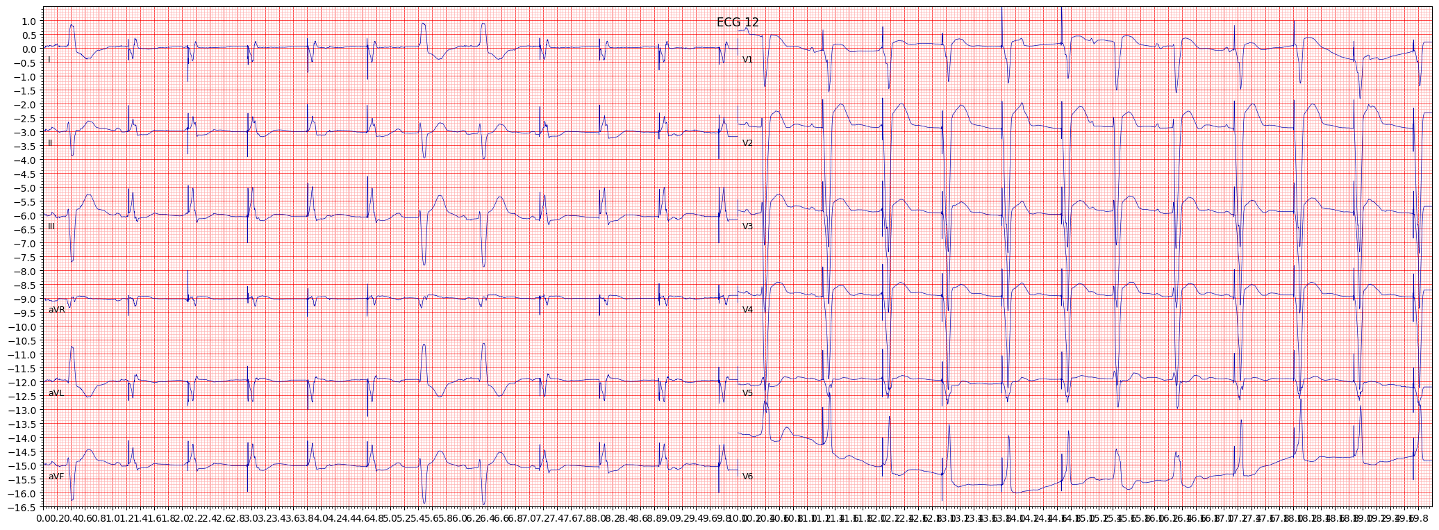 normal functioning artifcial pacemaker (PACE) example 2486