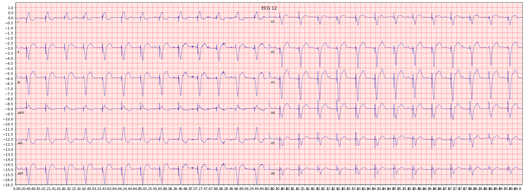 normal functioning artifcial pacemaker (PACE) example 2664