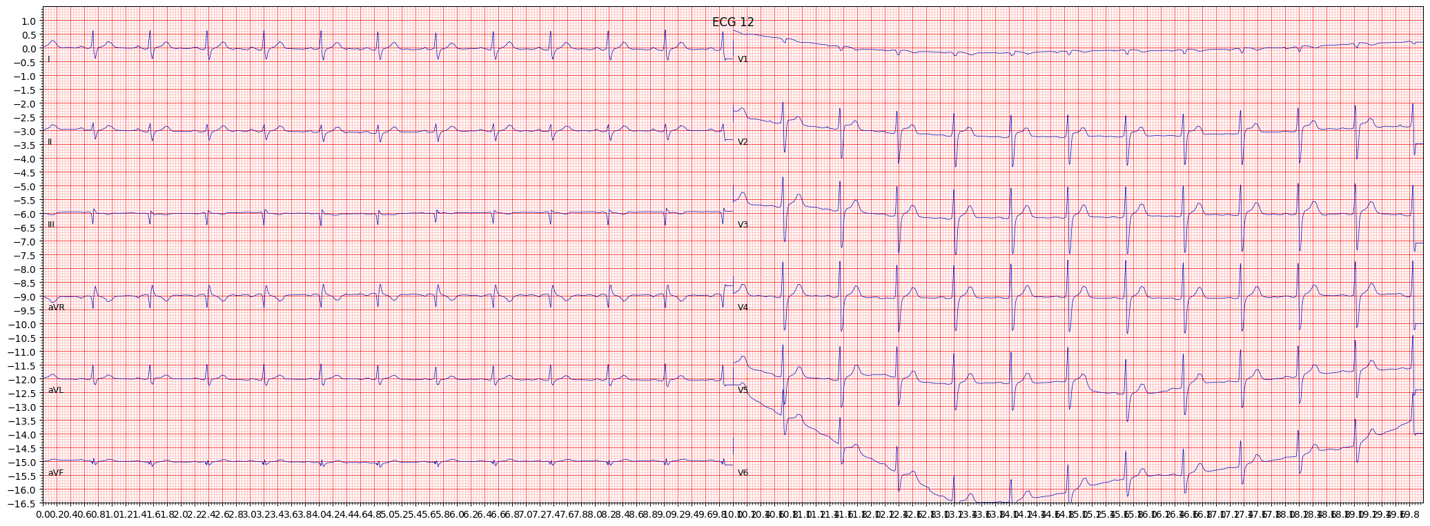 non-specifc intraventricular conduction disturbance (block) (IVCD) example 2668