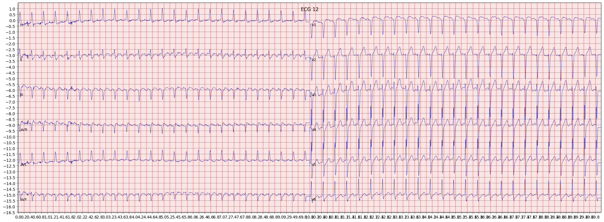atrial futter (AFLT) example 2739