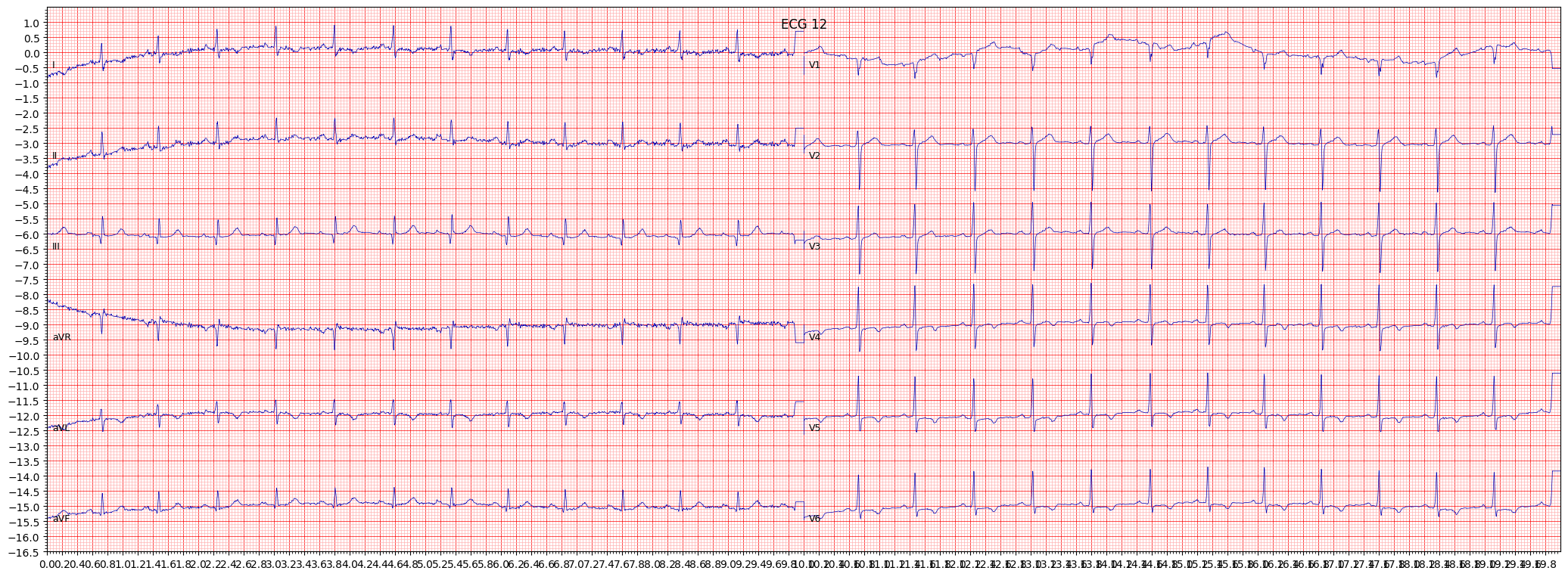 subendocardial injury in anterolateral leads (INJAL) example 2772