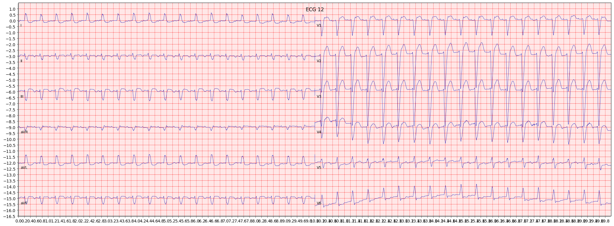 complete left bundle branch block (CLBBB) example 279