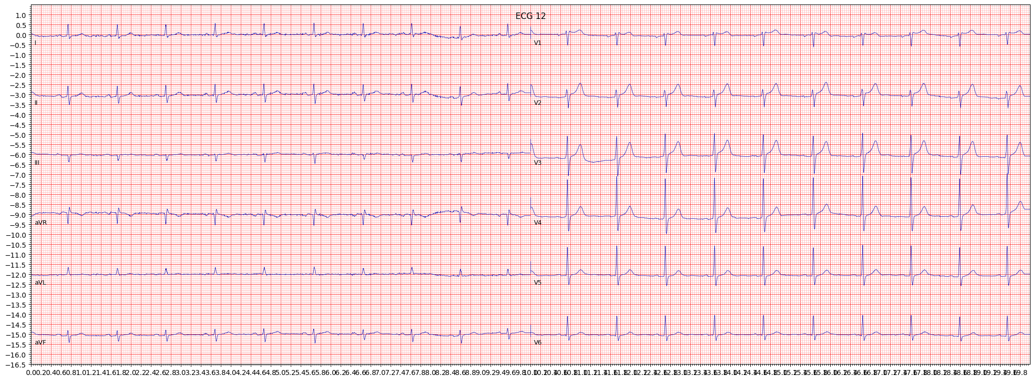 Normal ECG (NORM) example 280