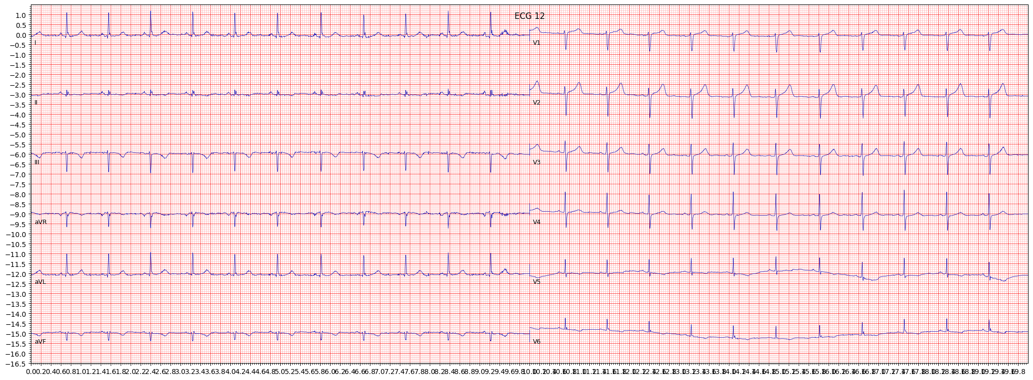 ischemic in inferolateral leads (ISCIL) example 2808