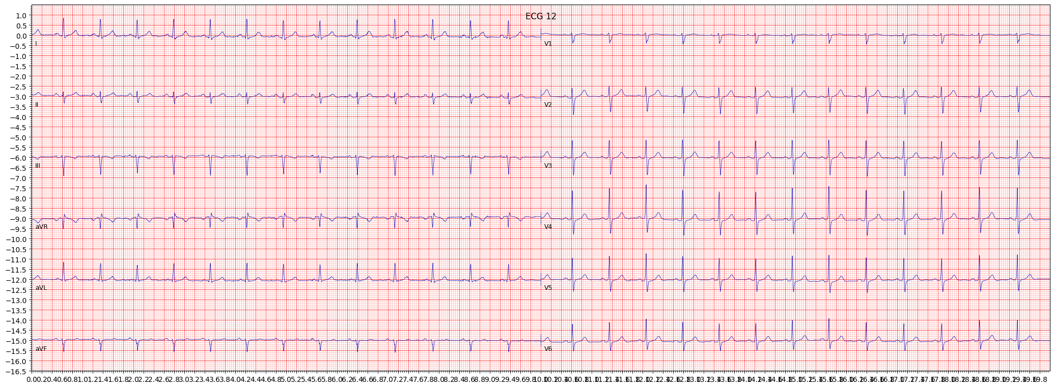 left anterior fascicular block (LAFB) example 285