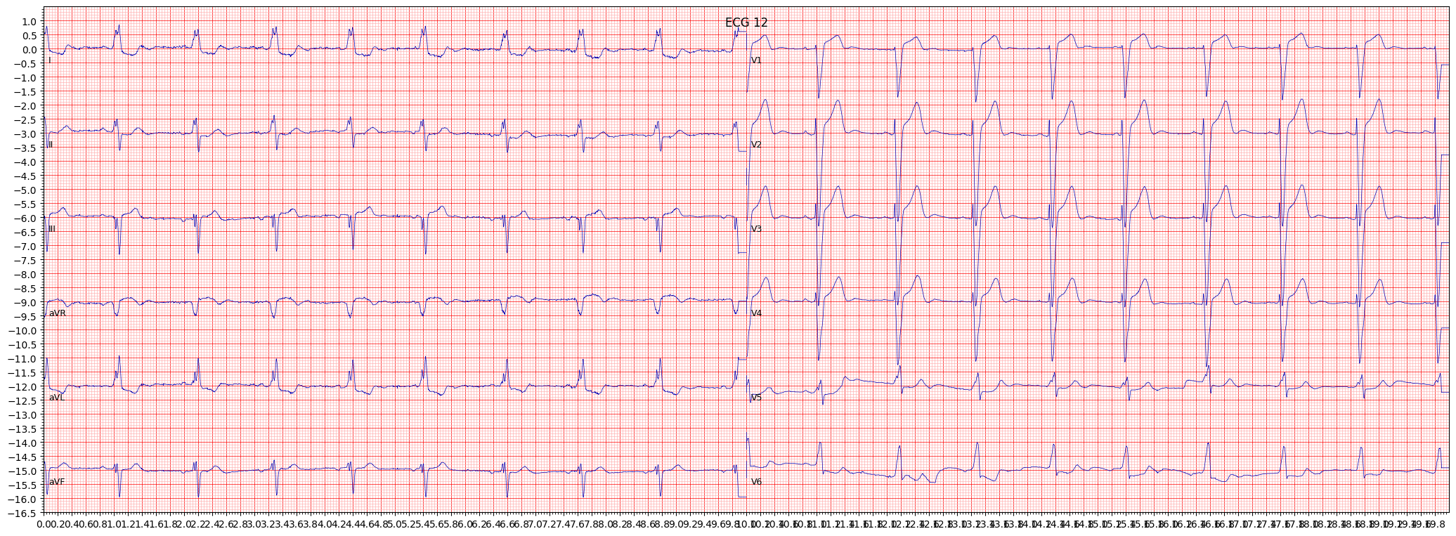 complete left bundle branch block (CLBBB) example 286