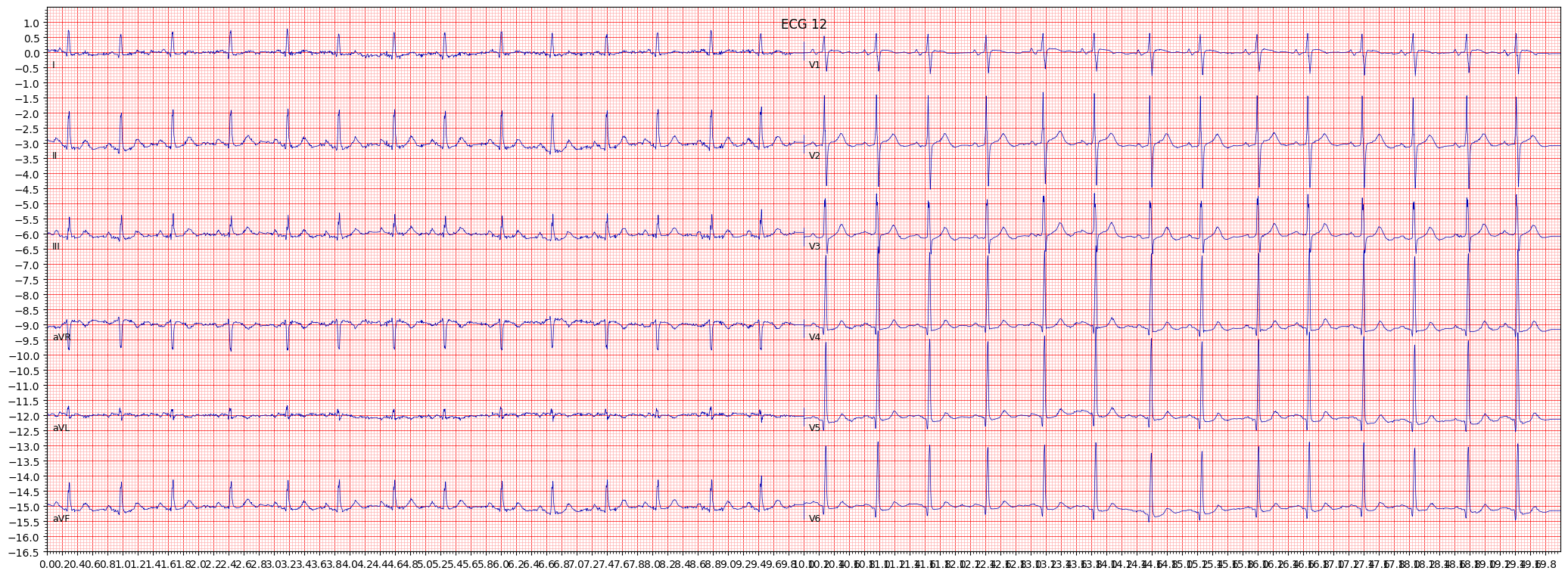 non-specifc intraventricular conduction disturbance (block) (IVCD) example 2876