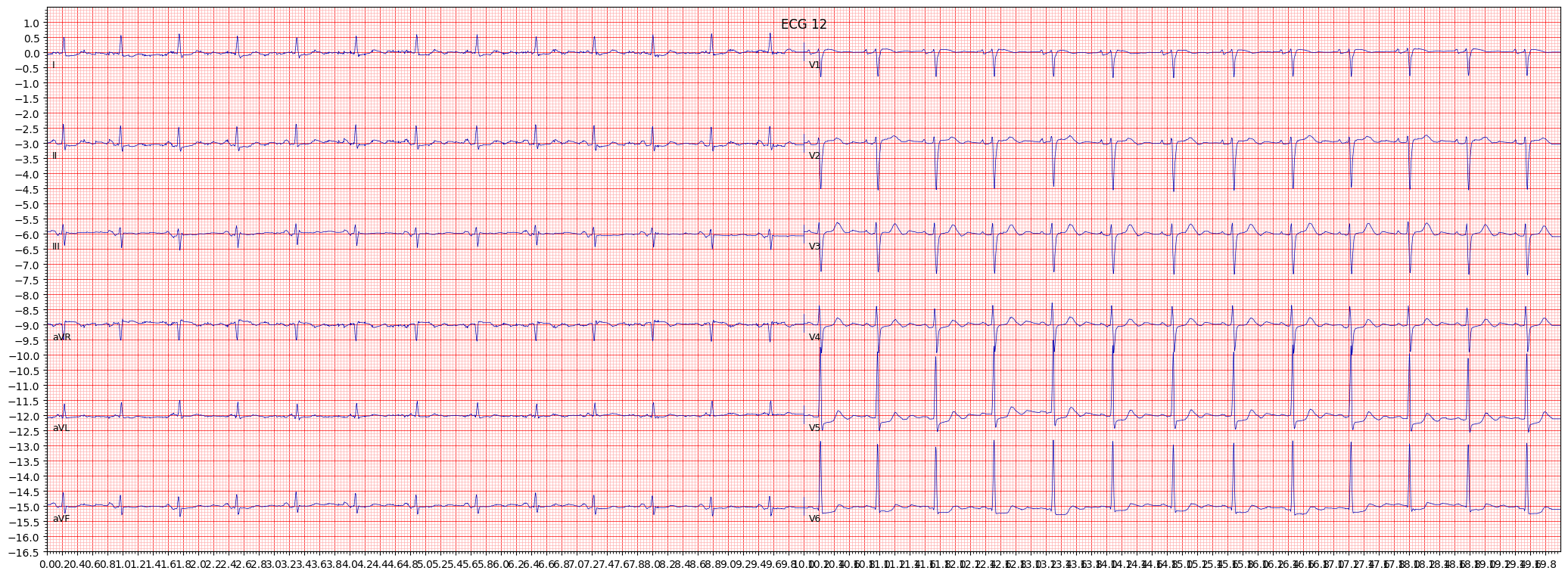 non-specifc ischemic (ISC_) example 2891