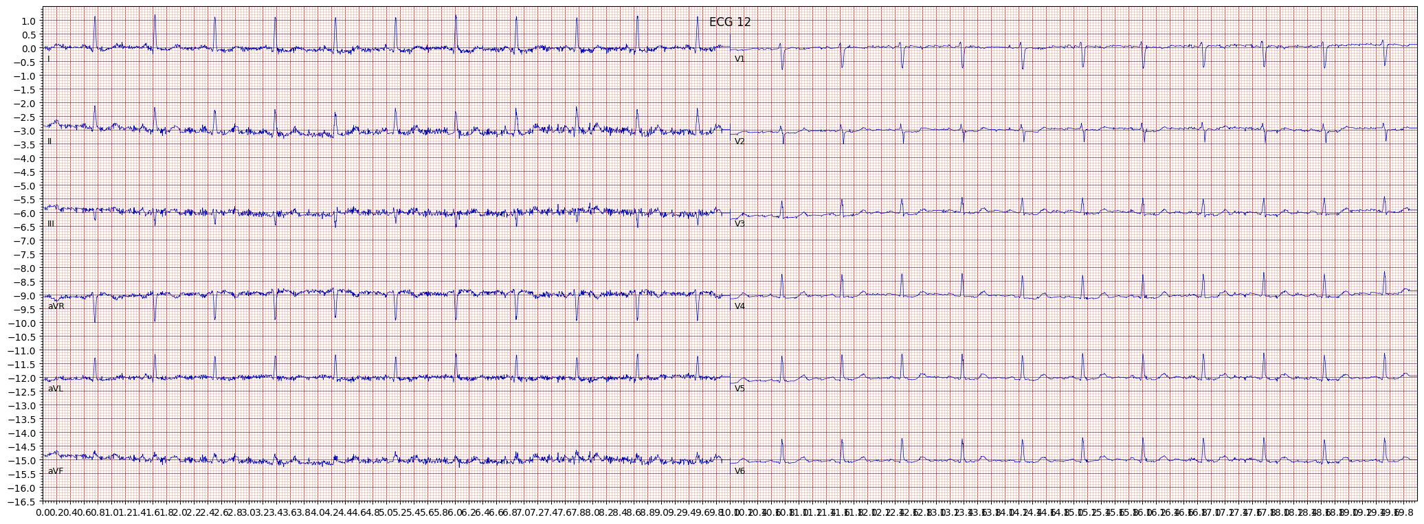 non-specifc ST changes (NST_) example 295