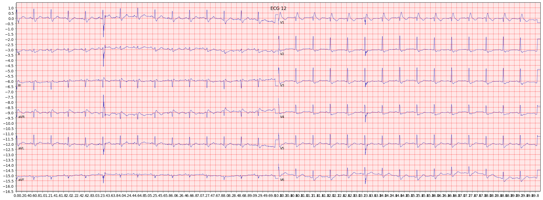 complete right bundle branch block (CRBBB) example 3129