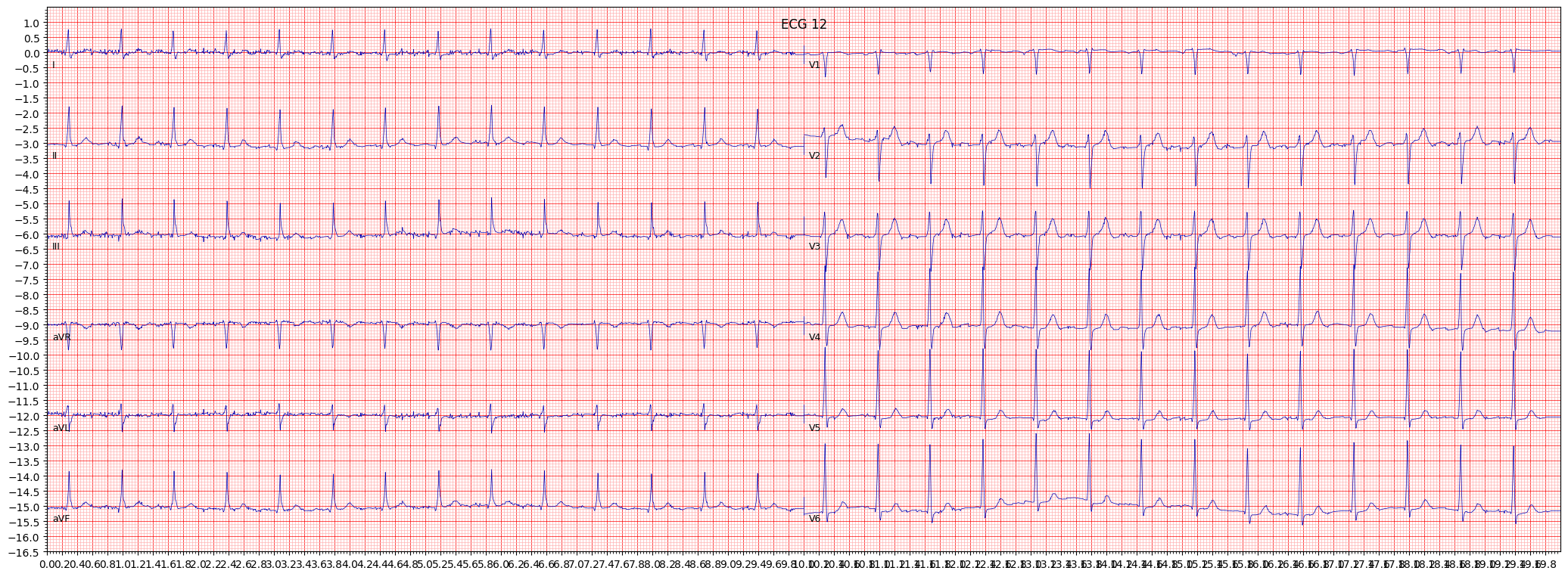 non-specifc intraventricular conduction disturbance (block) (IVCD) example 3251