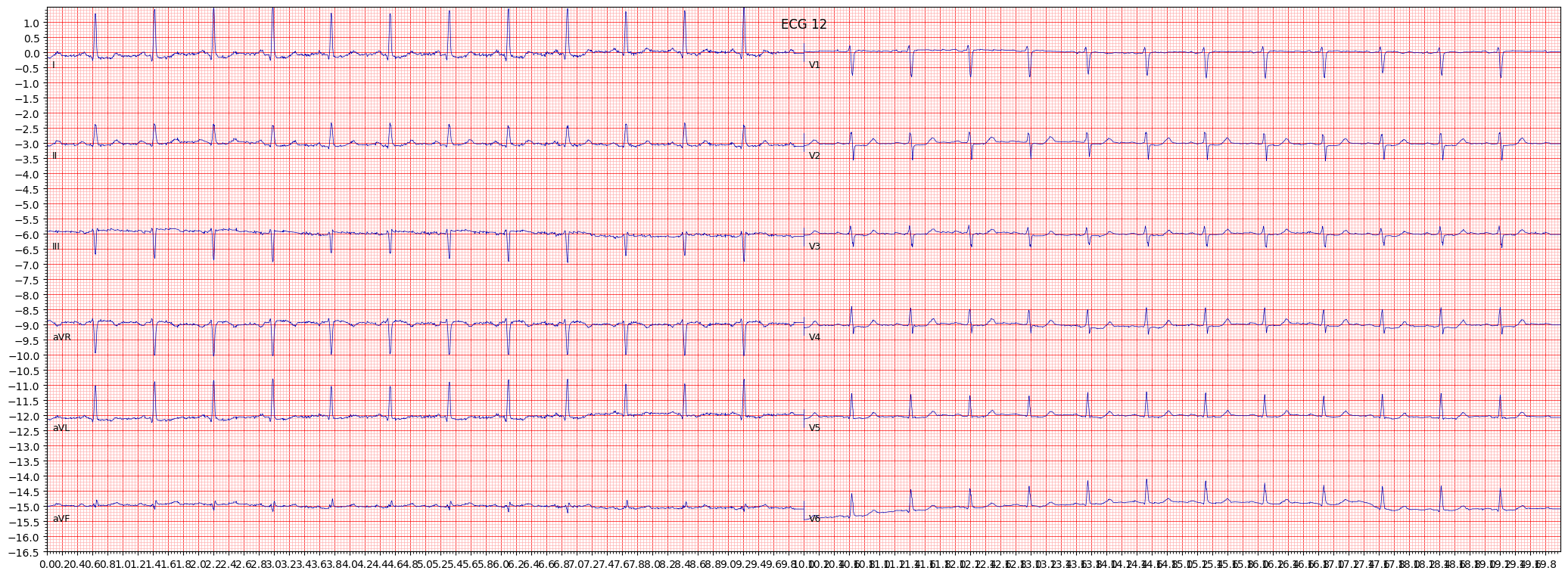 non-specifc ST changes (NST_) example 326