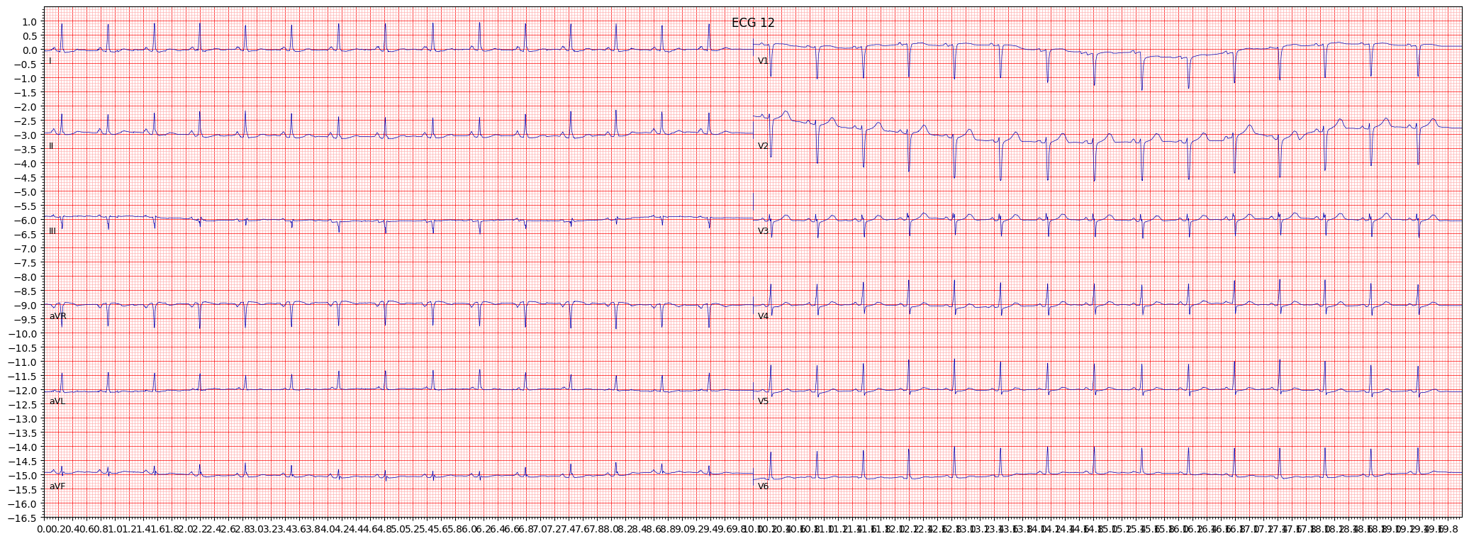 non-diagnostic T abnormalities (NDT) example 329