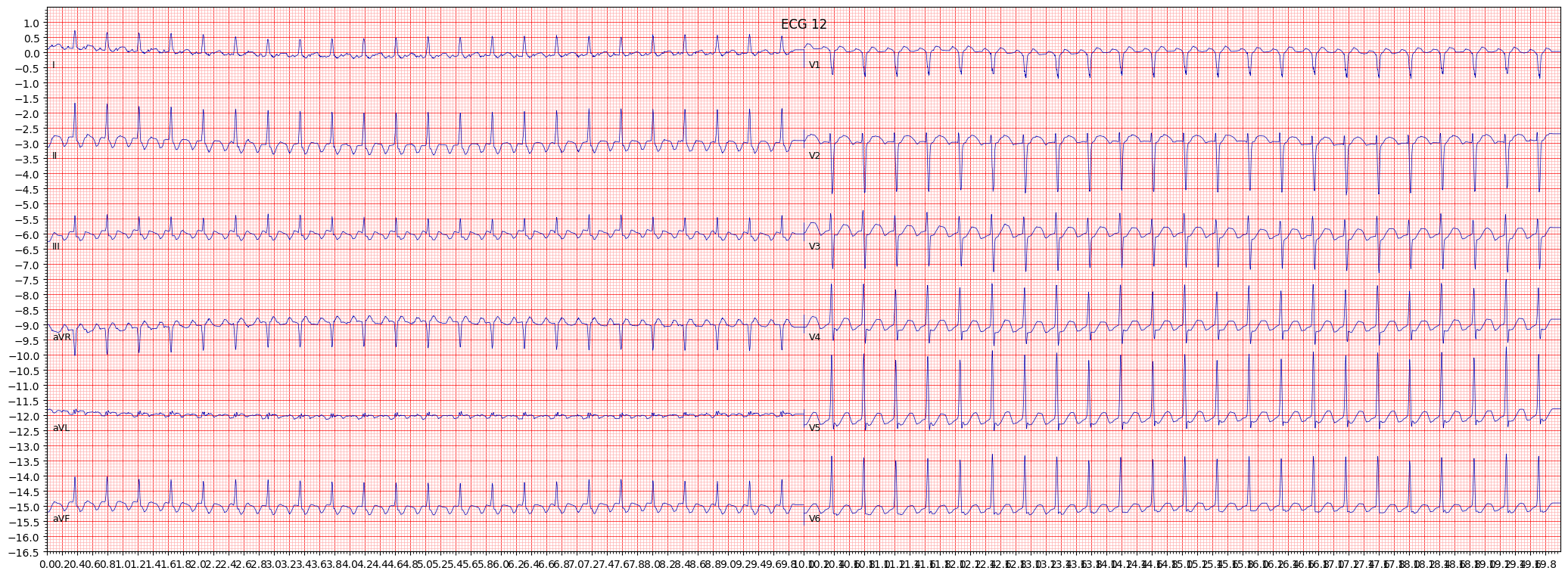 atrial futter (AFLT) example 3306