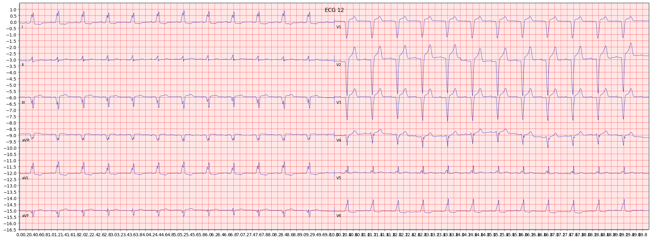 complete left bundle branch block (CLBBB) example 338