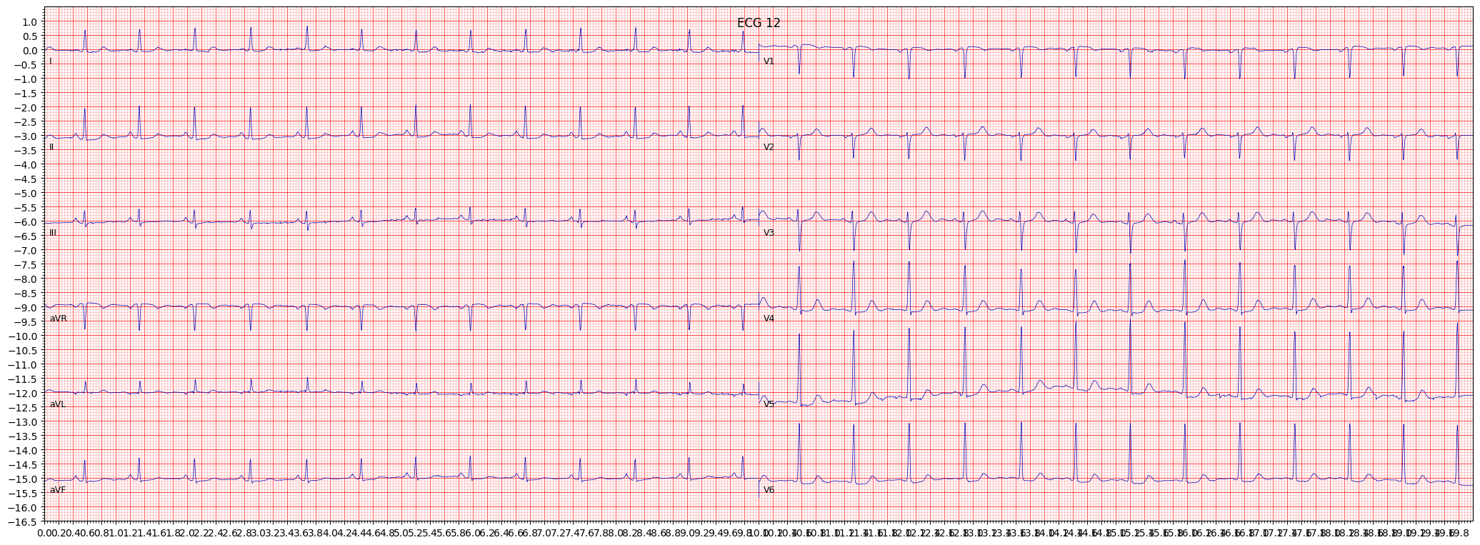 non-diagnostic T abnormalities (NDT) example 341