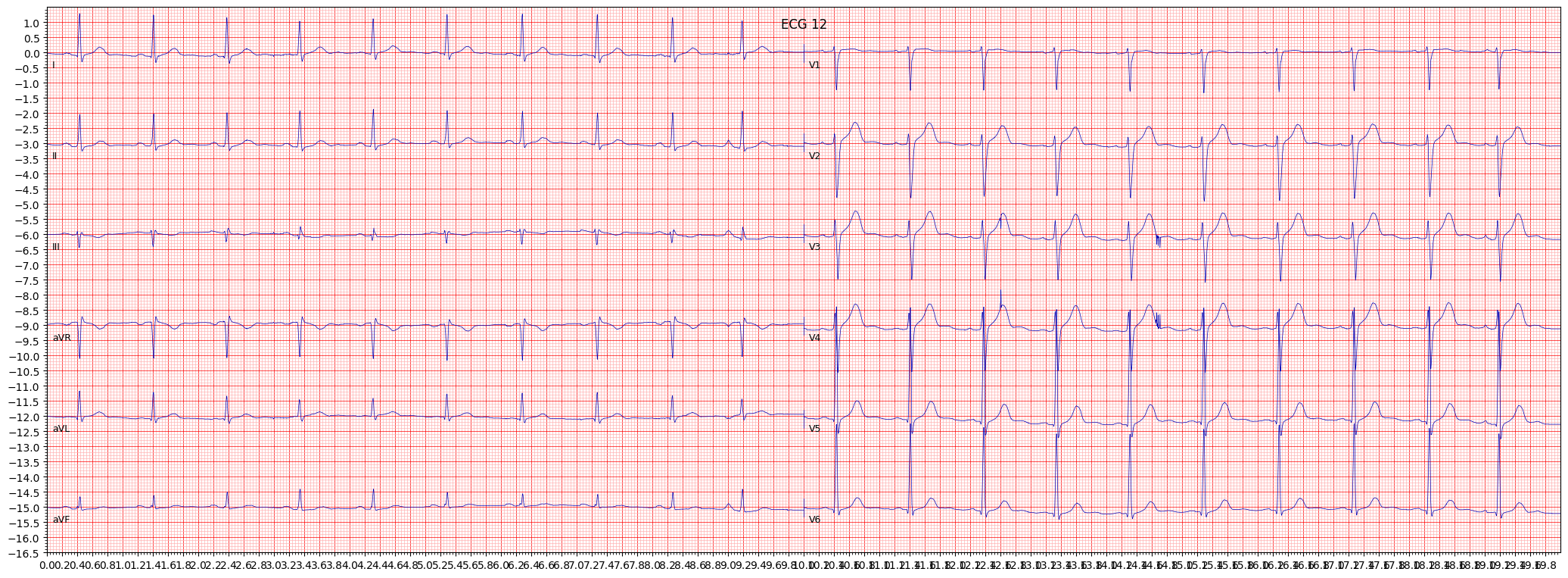 left ventricular hypertrophy (LVH) example 3425
