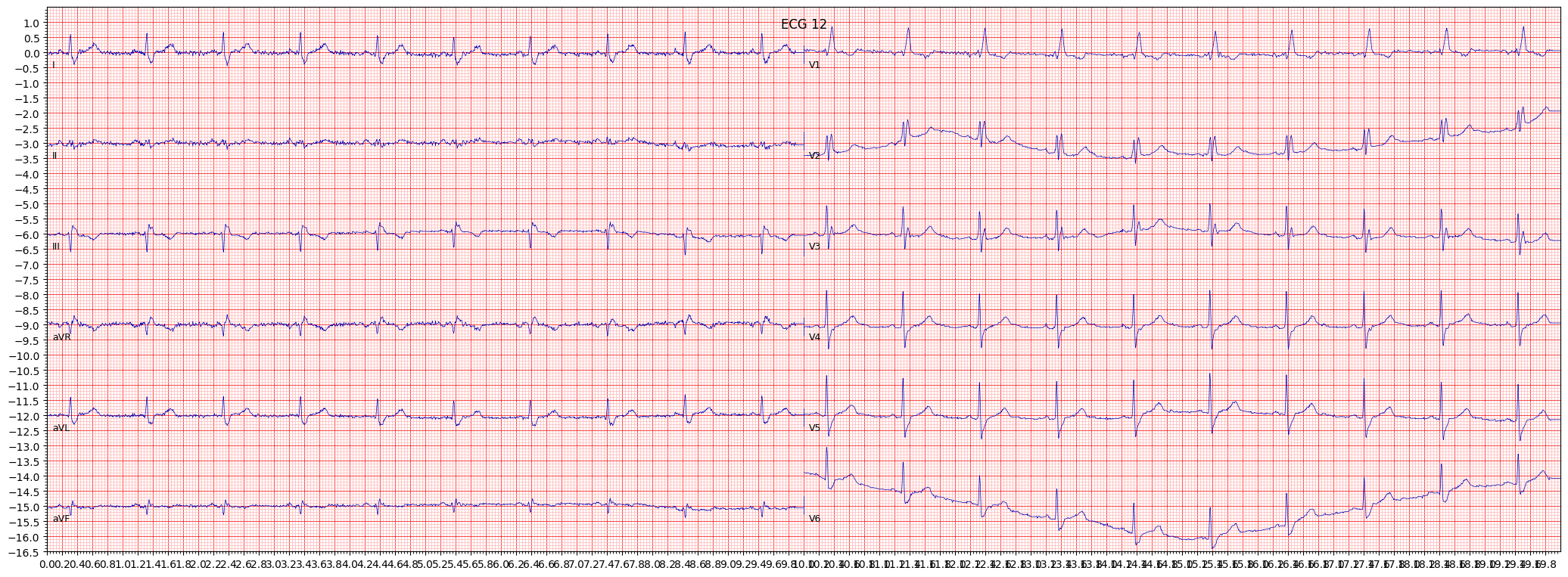 complete right bundle branch block (CRBBB) example 3461