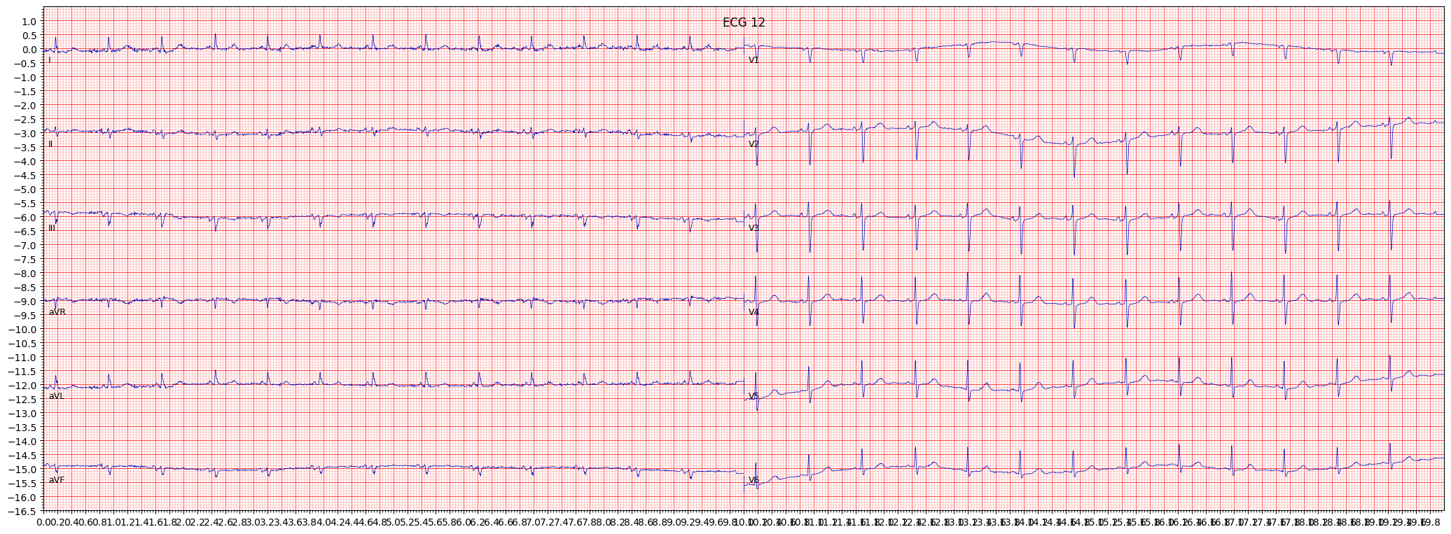 left anterior fascicular block (LAFB) example 348