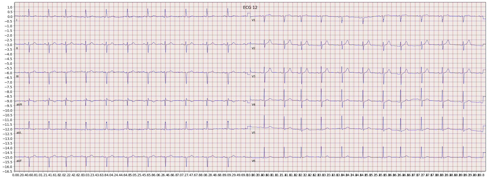 left anterior fascicular block (LAFB) example 350