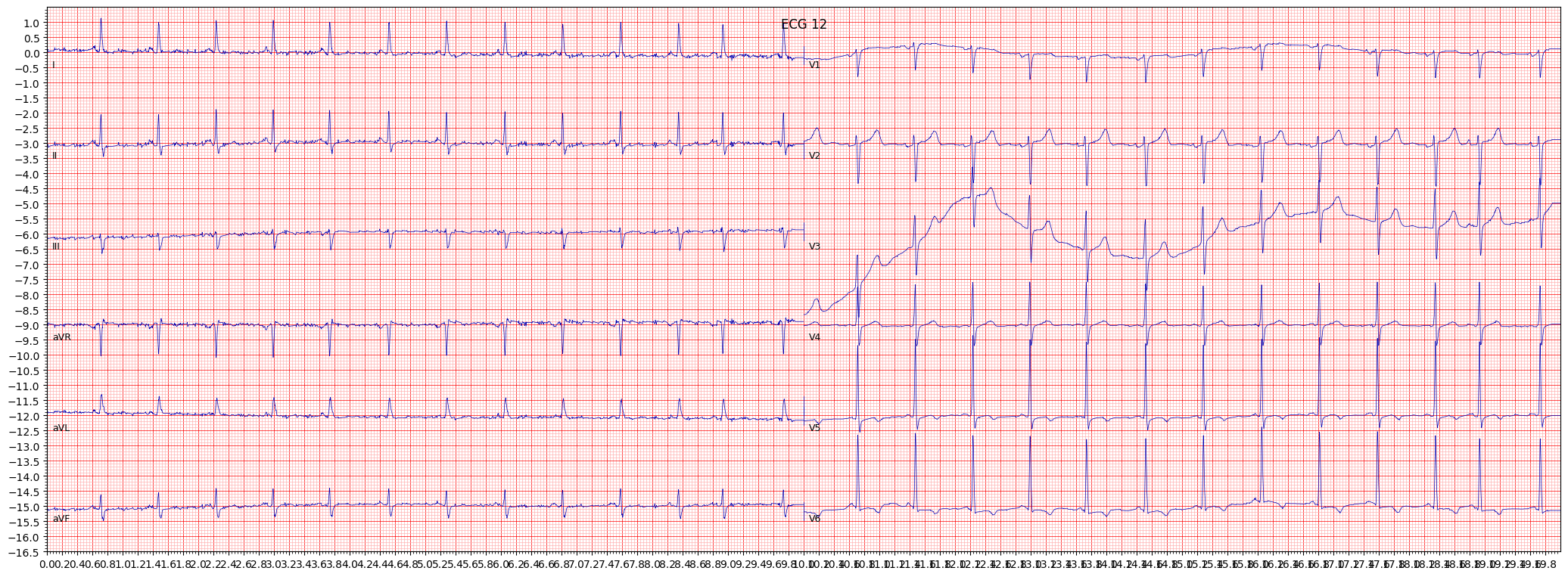 ischemic in lateral leads (ISCLA) example 3531