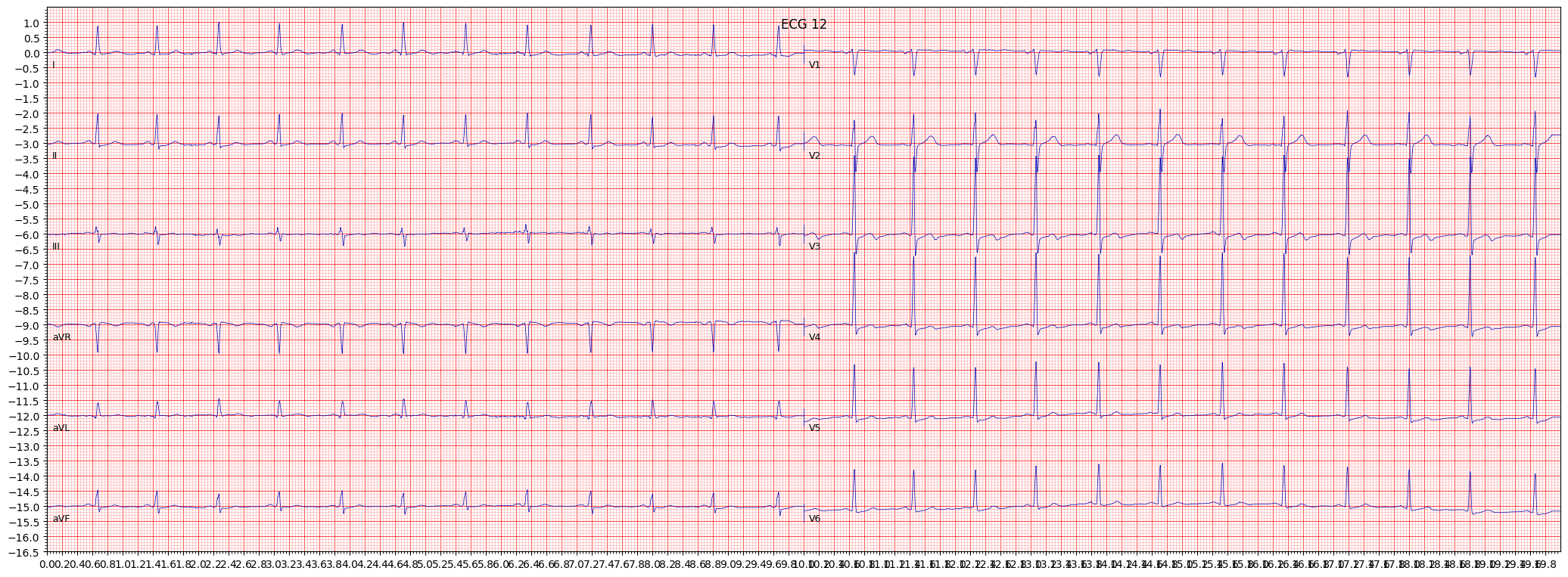 ischemic in anteroseptal leads (ISCAS) example 3590