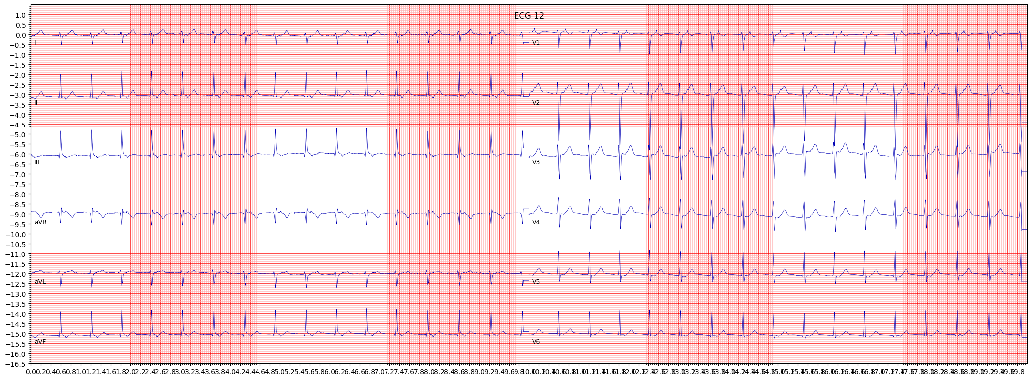 left posterior fascicular block (LPFB) example 377