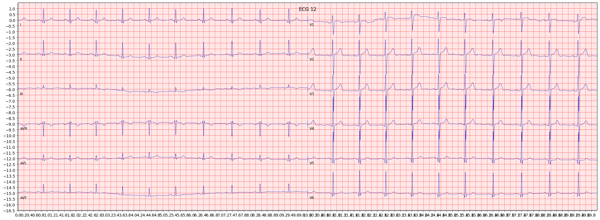 left ventricular hypertrophy (LVH) example 3785