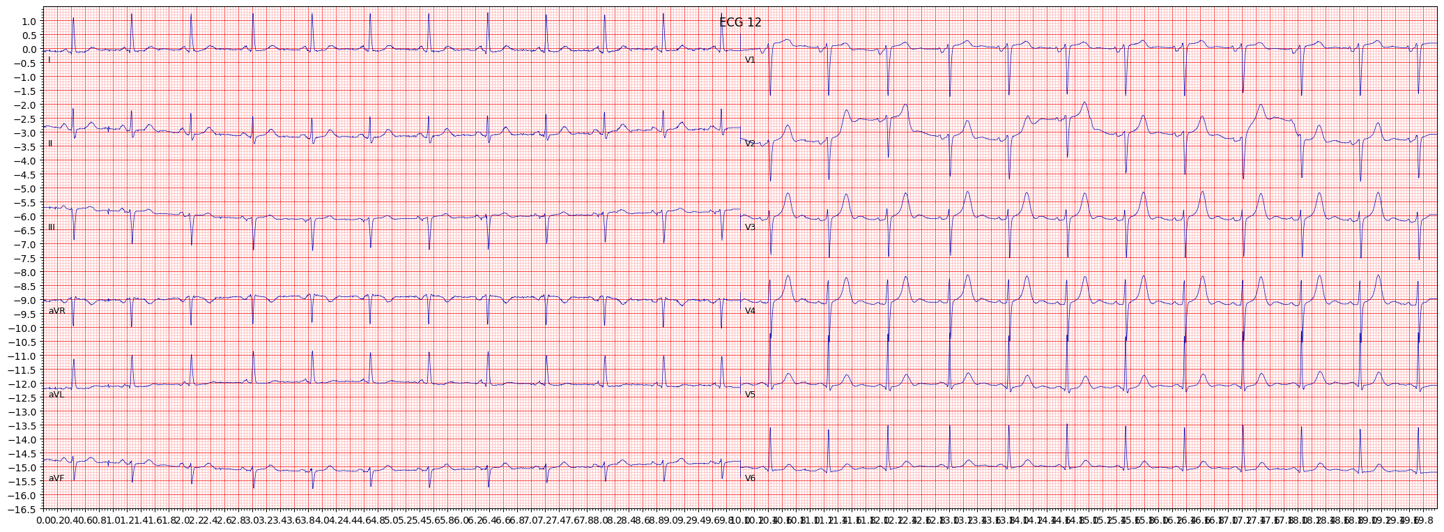 left ventricular hypertrophy (LVH) example 3790