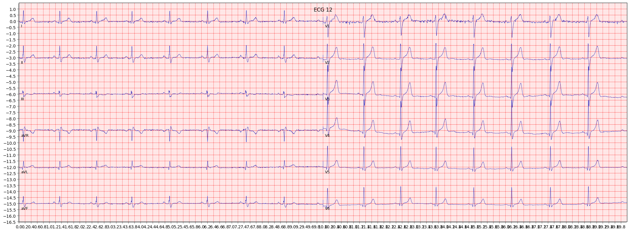 non-specifc intraventricular conduction disturbance (block) (IVCD) example 3995